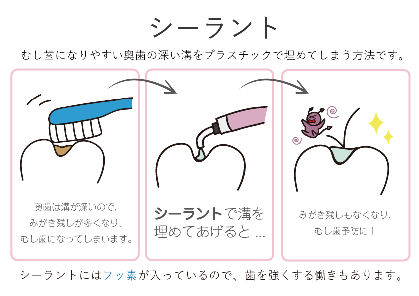 シーラントとは 中津まさデンタルクリニック