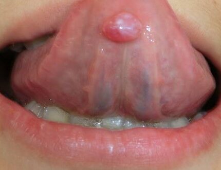 ブランディンヌーン嚢胞とは（舌の裏側に水ぶくれができた）￼
