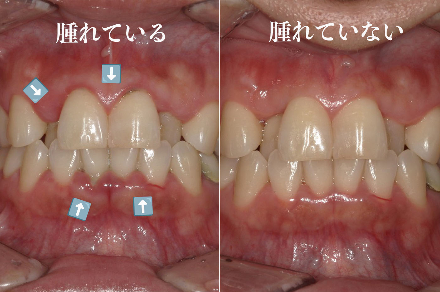 歯周病の比較